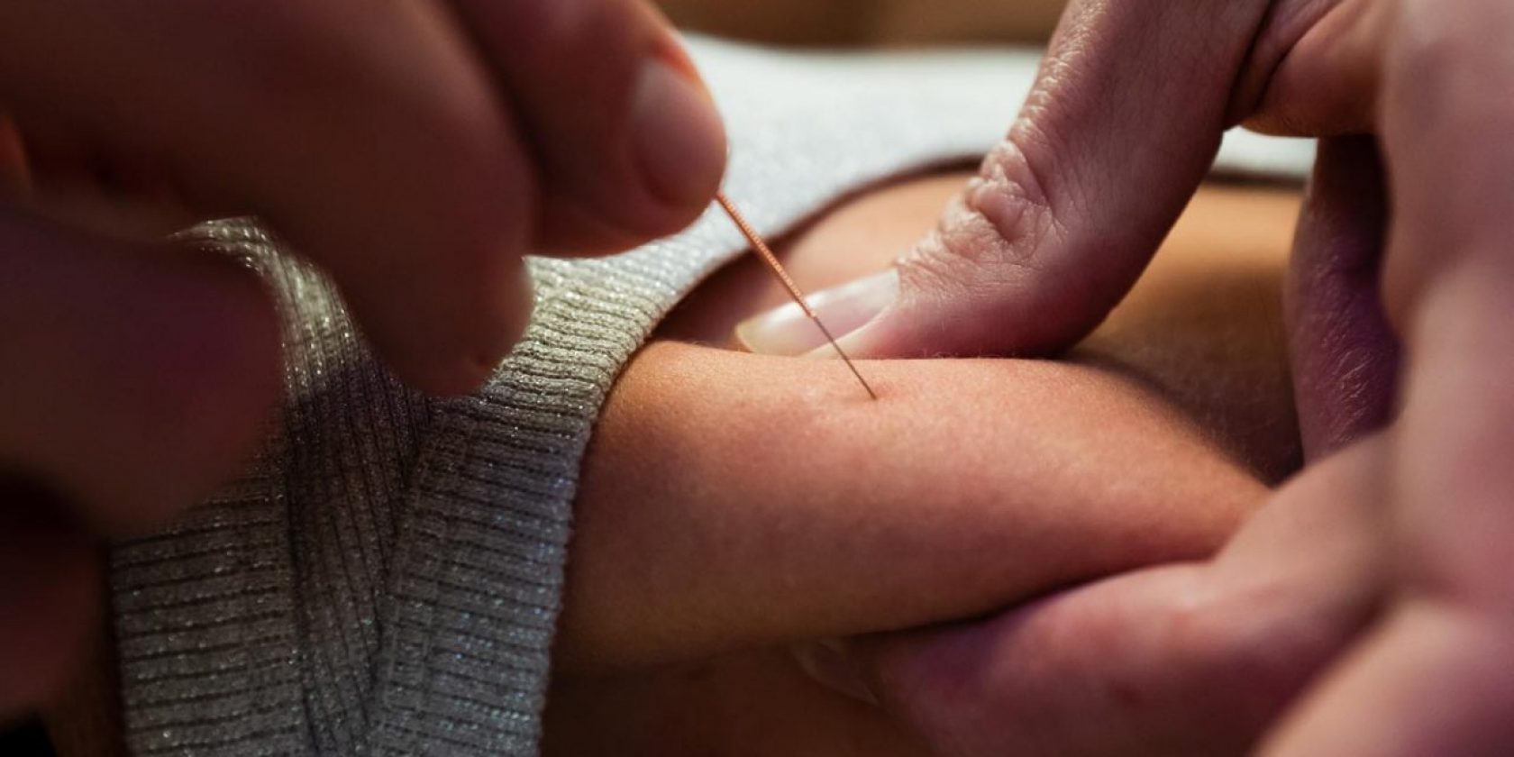 Dry needling